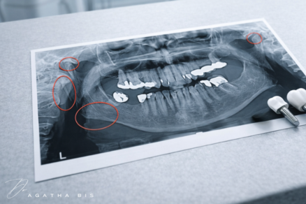 Dental Implant Failure
