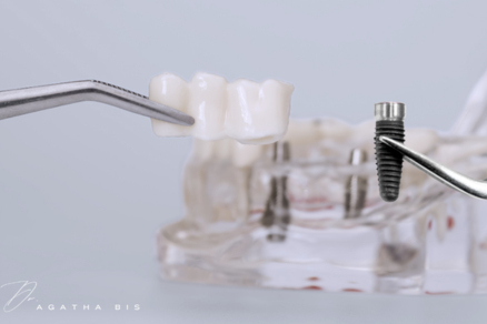 Dental Implants vs. Bridges in Oakville
