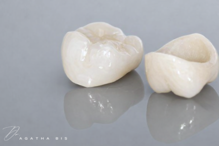 Dental Crowns