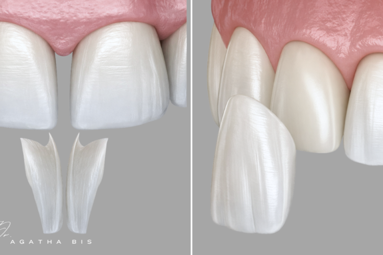 Dental Veneers vs Dental Bonding in Oakville A Structural Comparison_Dr. Agatha Bis