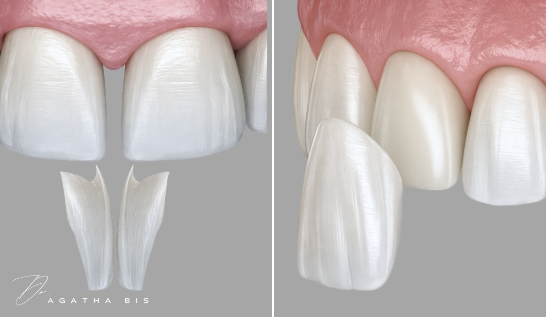 Dental Veneers vs Dental Bonding in Oakville A Structural Comparison_Dr. Agatha Bis