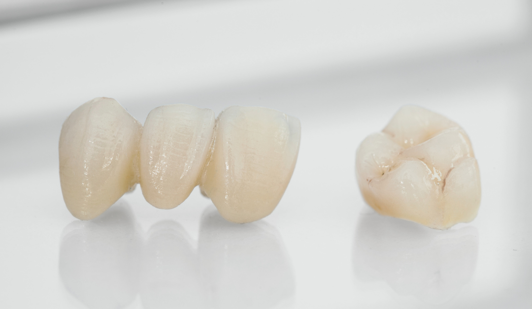 Dental Crowns and Bridges Oakville