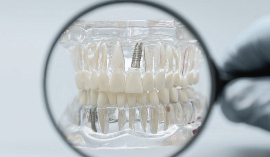 Dental Implants Oakville