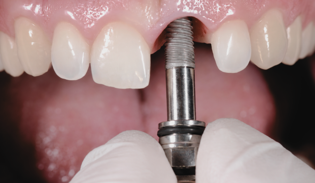 When Implants May Be Considered