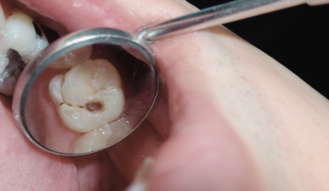 dental filling Oakville