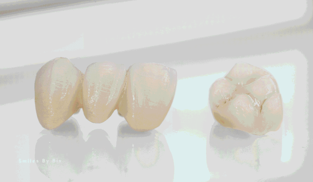 Crowns vs Bridges