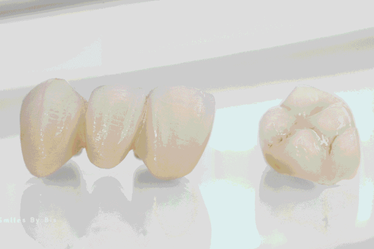 Crowns vs Bridges