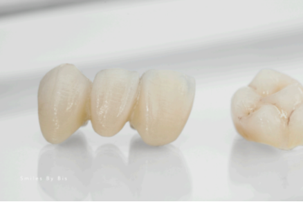 Crowns vs Bridges