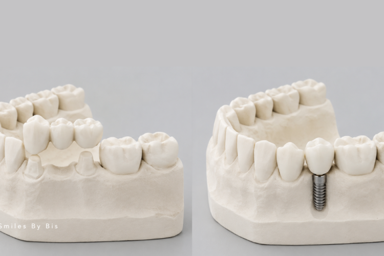 Dental Implants vs. Bridges_ Which Is Better for Missing Teeth