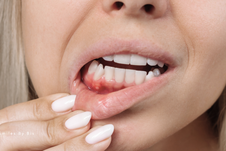 Gum Disease