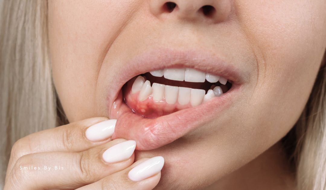 Gum Disease