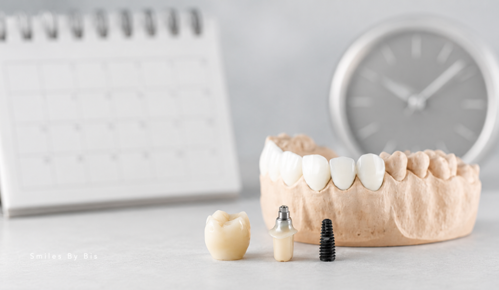 How Long Do Dental Implants Last?