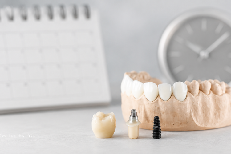How Long Do Dental Implants Last?