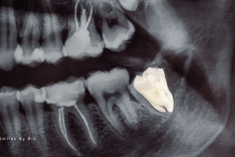 Impacted Wisdom Teeth