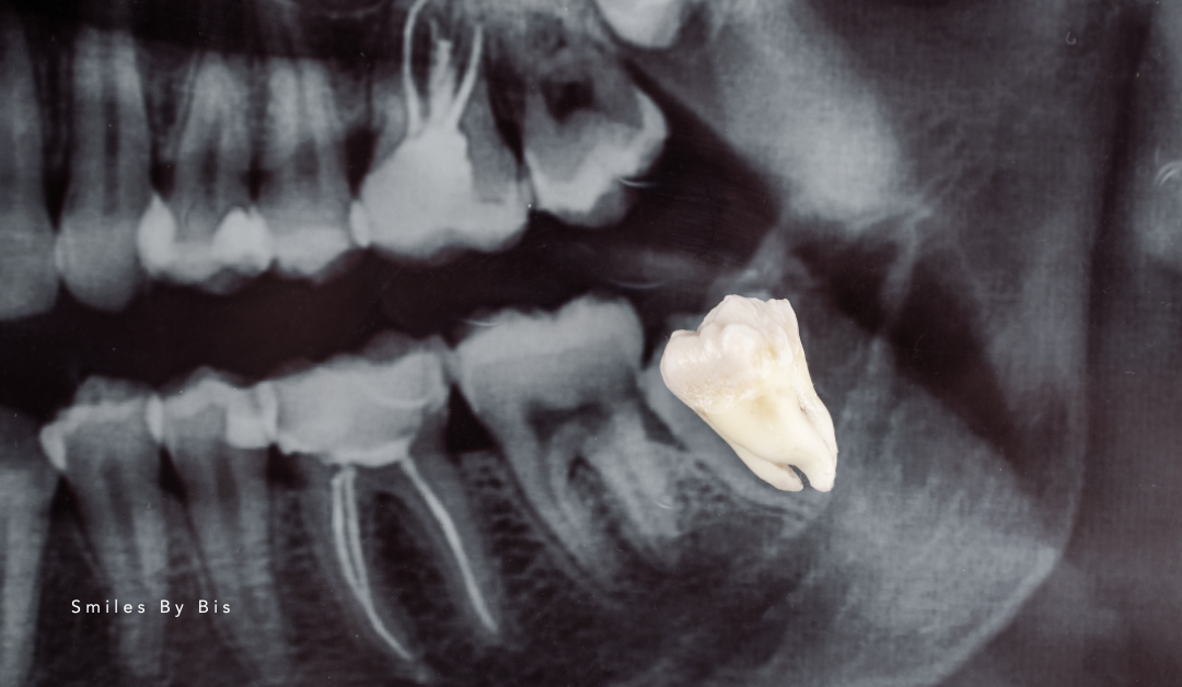 Impacted Wisdom Teeth