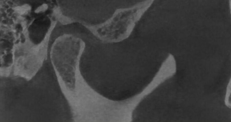 CBCT sagittal view of the TMJ showing the condyle in the joint
