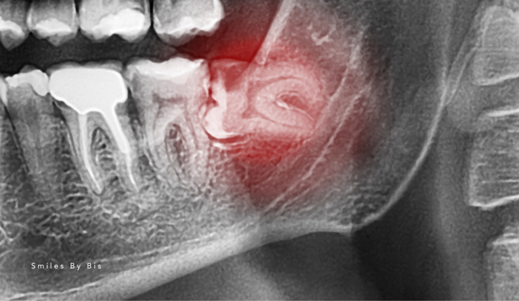 Wisdom Teeth