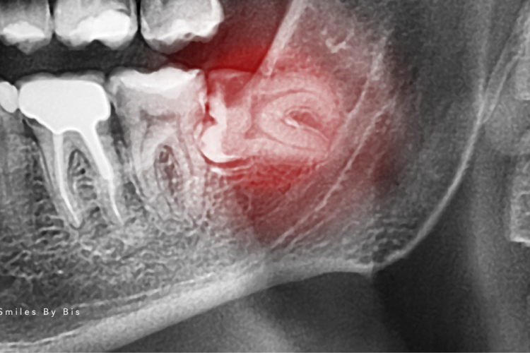 Wisdom Teeth